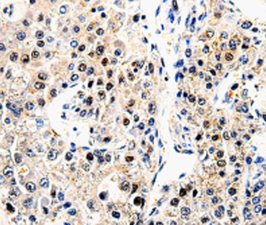 Immunohistochemistry of paraffin-embedded Human liver cancer  using beta Amyloid Polyclonal Antibody at dilution of 1:100