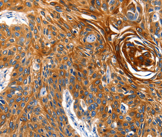 Immunohistochemistry of paraffin-embedded Human esophagus cancer tissue using AQP5 Polyclonal Antibody at dilution 1:40