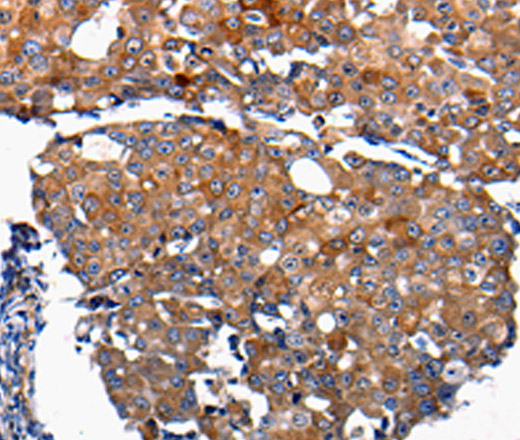 Immunohistochemistry of paraffin-embedded Human breast cancer using FGF2 Polyclonal Antibody at dilution of 1:100