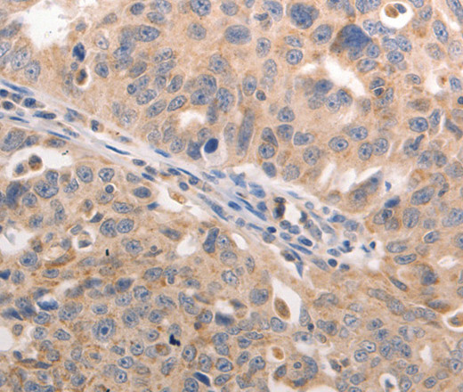 Immunohistochemistry of paraffin-embedded Human lung cancer using BGLAP Polyclonal Antibody at dilution of 1:60