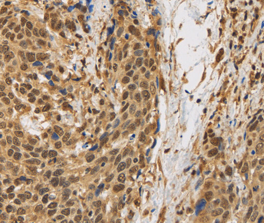 Immunohistochemistry of paraffin-embedded Human cervical cancer using BRAF Polyclonal Antibody at dilution of 1:30