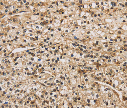 Immunohistochemistry of paraffin-embedded Human prostate cancer using BRAF Polyclonal Antibody at dilution of 1:30