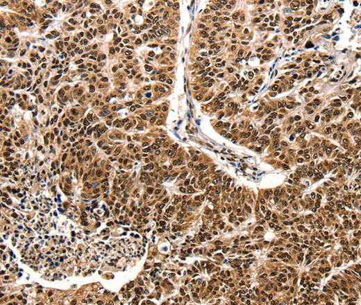 Immunohistochemistry of paraffin-embedded Human lung cancer tissue using CCL2 Polyclonal Antibody at dilution 1:50