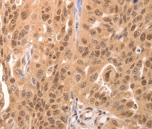 Immunohistochemistry of paraffin-embedded Human breast cancer tissue using JUND Polyclonal Antibody at dilution 1:60