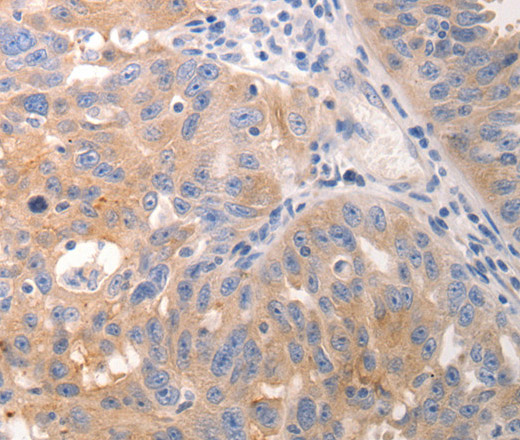 Immunohistochemistry of paraffin-embedded Human breast cancer tissue using CK-6A/B/C Polyclonal Antibody at dilution 1:50
