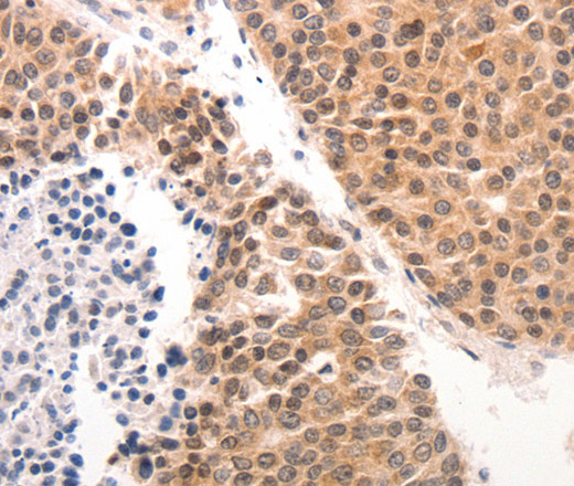 Immunohistochemistry of paraffin-embedded Human ovarian cancer tissue using CK-6A/B/C Polyclonal Antibody at dilution 1:50