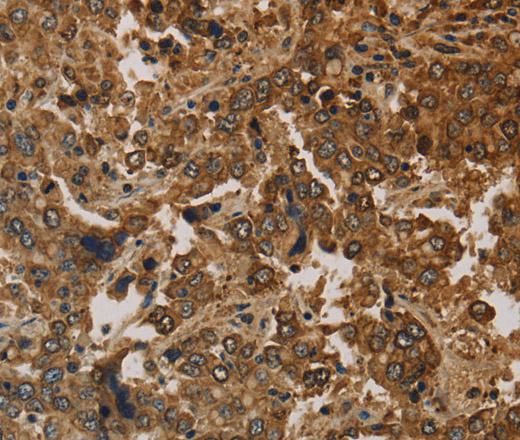 Immunohistochemistry of paraffin-embedded Human liver cancer using CK-16 Polyclonal Antibody at dilution of 1:30