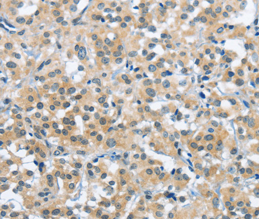 Immunohistochemistry of paraffin-embedded Human thyroid cancer tissue using TRDMT1 Polyclonal Antibody at dilution 1:40