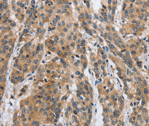 Immunohistochemistry of paraffin-embedded Human esophagus cancer tissue using DSP Polyclonal Antibody at dilution 1:40