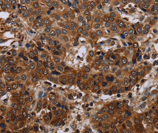 Immunohistochemistry of paraffin-embedded Human liver cancer using SLC1A6 Polyclonal Antibody at dilution of 1:40