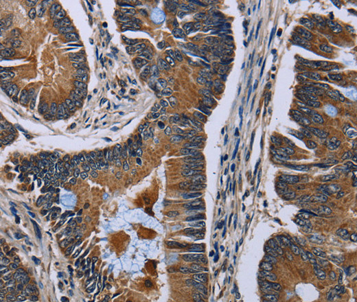 Immunohistochemistry of paraffin-embedded Human colon cancer using SLC1A6 Polyclonal Antibody at dilution of 1:40