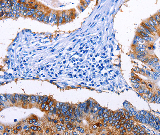 Immunohistochemistry of paraffin-embedded Human colon cancer tissue using EPCAM Polyclonal Antibody at dilution 1:45
