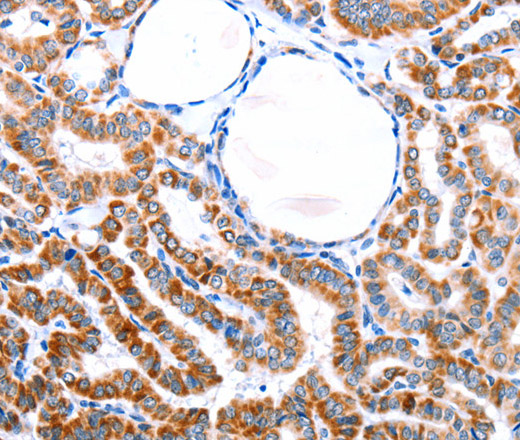 Immunohistochemistry of paraffin-embedded Human thyroid cancer tissue using ER alpha Polyclonal Antibody at dilution 1:76