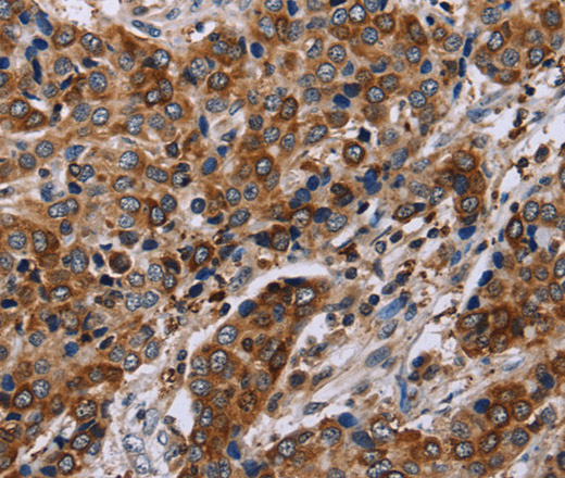 Immunohistochemistry of paraffin-embedded Human liver cancer using FAF1 Polyclonal Antibody at dilution of 1:50