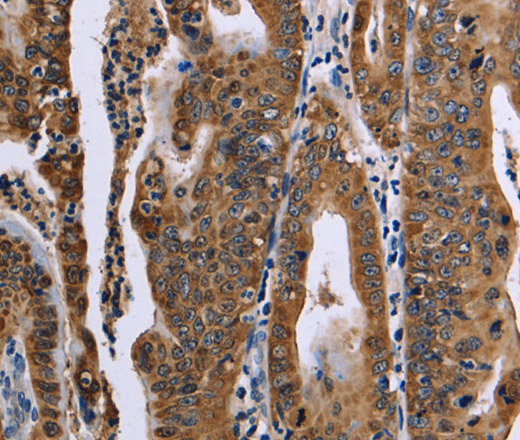 Immunohistochemistry of paraffin-embedded Human gastric cancer using FAF1 Polyclonal Antibody at dilution of 1:50