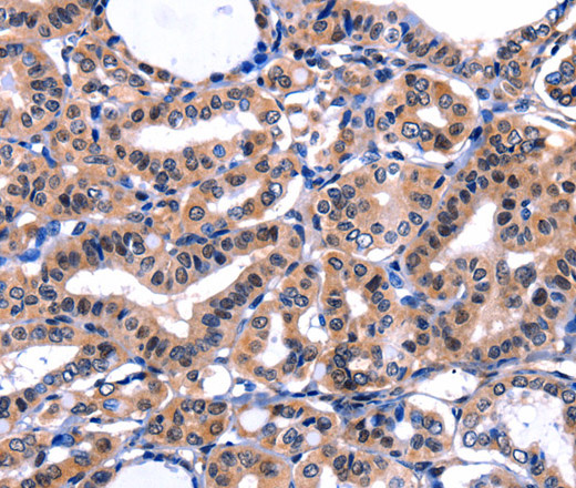 Immunohistochemistry of paraffin-embedded Human thyroid cancer tissue using FBN1 Polyclonal Antibody at dilution 1:47