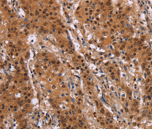 Immunohistochemistry of paraffin-embedded Human gastic cancer using FOSL1 Polyclonal Antibody at dilution of 1:30