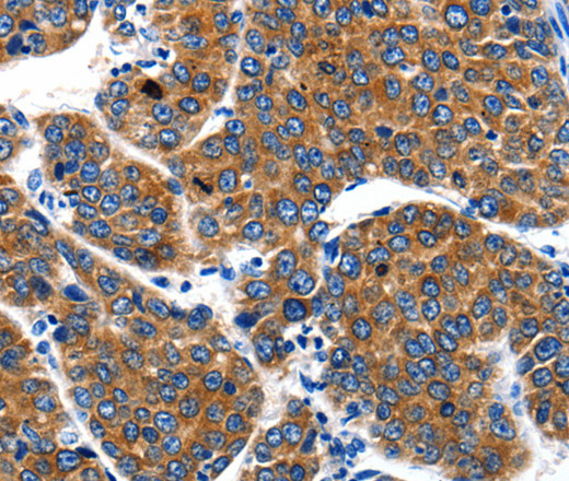 Immunohistochemistry of paraffin-embedded Human liver cancer using IGF2BP1 Polyclonal Antibody at dilution of 1:40