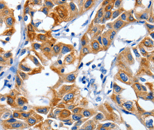 Immunohistochemistry of paraffin-embedded Human lung cancer using IGF2BP1 Polyclonal Antibody at dilution of 1:40