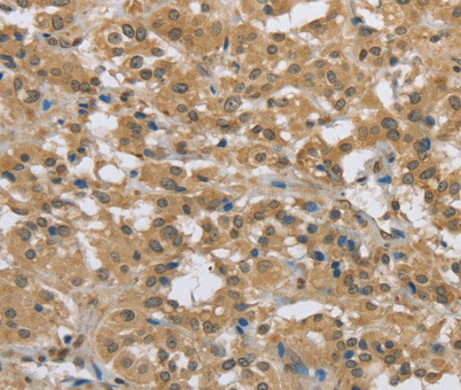 Immunohistochemistry of paraffin-embedded Human thyroid cancer tissue using PKD1 Polyclonal Antibody at dilution 1:50