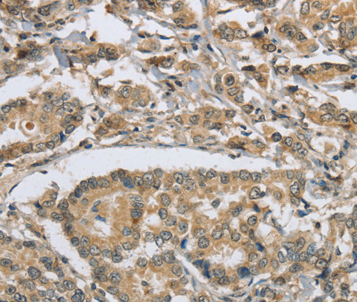 Immunohistochemistry of paraffin-embedded Human breast cancer tissue using PKD1 Polyclonal Antibody at dilution 1:50