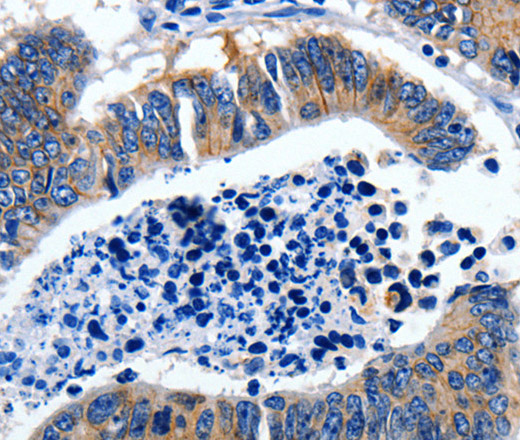 Immunohistochemistry of paraffin-embedded Human colon cancer tissue using GAD2  Polyclonal Antibody at dilution 1:30