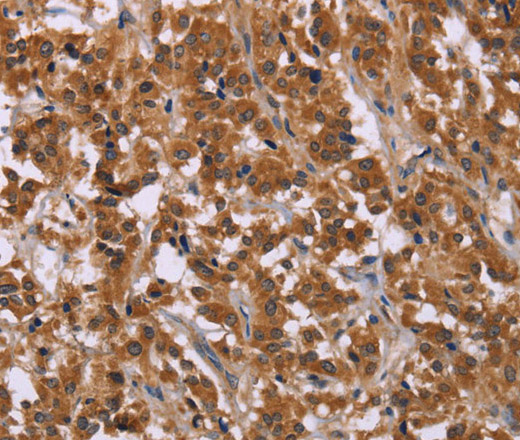 Immunohistochemistry of paraffin-embedded Human thyroid cancer using CMTM6 Polyclonal Antibody at dilution of 1:30