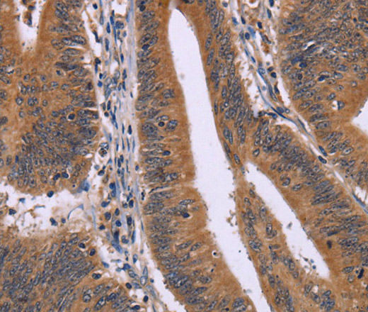 Immunohistochemistry of paraffin-embedded Human colon cancer using CMTM6 Polyclonal Antibody at dilution of 1:30