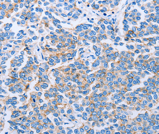 Immunohistochemistry of paraffin-embedded Human breast cancer using Claudin 4 Polyclonal Antibody at dilution of 1:50