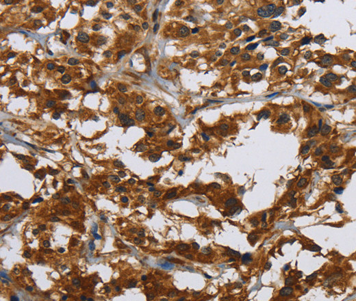 Immunohistochemistry of paraffin-embedded Human thyroid cancer tissue using Claudin 2 Polyclonal Antibody at dilution 1:30