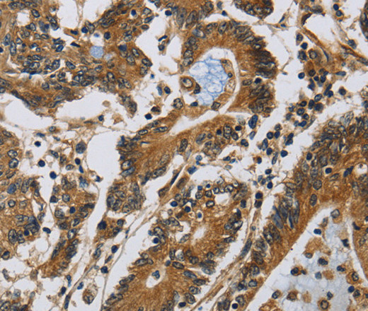 Immunohistochemistry of paraffin-embedded Human colon cancer tissue using Claudin 2 Polyclonal Antibody at dilution 1:30