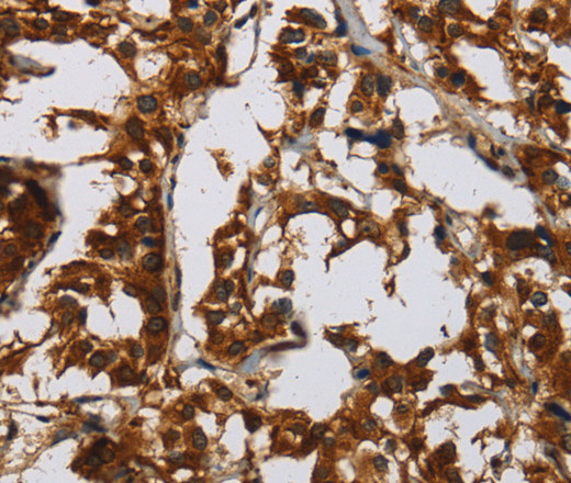 Immunohistochemistry of paraffin-embedded Human thyroid cancer tissue using Claudin 8 Polyclonal Antibody at dilution 1:50