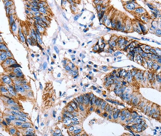 Immunohistochemistry of paraffin-embedded Human colon cancer using Claudin 7 Polyclonal Antibody at dilution of 1:50