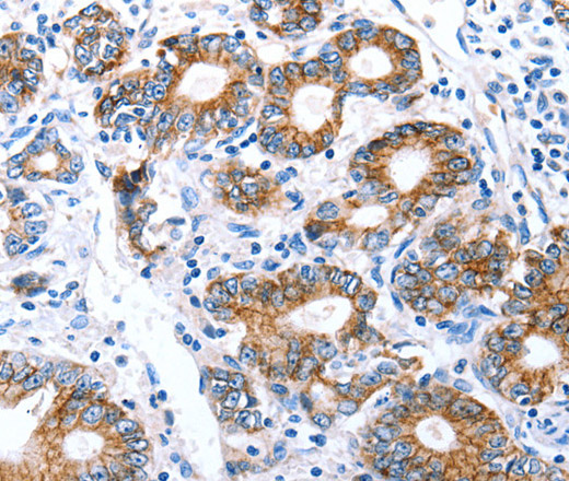 Immunohistochemistry of paraffin-embedded Human stomach cancer using Claudin 7 Polyclonal Antibody at dilution of 1:50