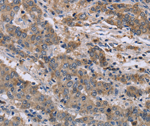 Immunohistochemistry of paraffin-embedded Human liver cancer tissue using GSN Polyclonal Antibody at dilution 1:40