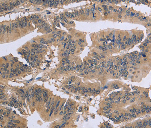 Immunohistochemistry of paraffin-embedded Human colon cancer tissue using GSN Polyclonal Antibody at dilution 1:40