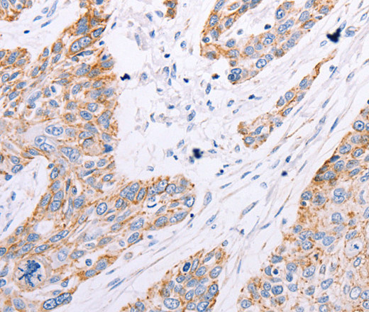 Immunohistochemistry of paraffin-embedded Human esophagus cancer tissue using GFRA3 Polyclonal Antibody at dilution 1:60