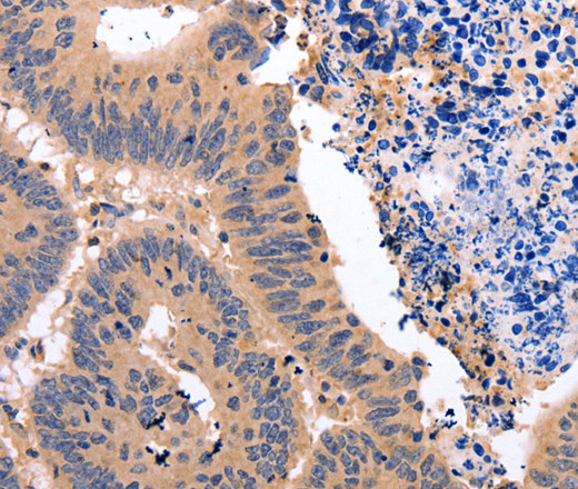 Immunohistochemistry of paraffin-embedded Human colon cancer tissue using Glucocorticoid Receptor Polyclonal Antibody at dilution 1:50