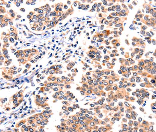 Immunohistochemistry of paraffin-embedded Human breast cancer using GNRHR Polyclonal Antibody at dilution of 1:117