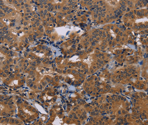 Immunohistochemistry of paraffin-embedded Human thyroid cancer tissue using GRK1 Polyclonal Antibody at dilution 1:30