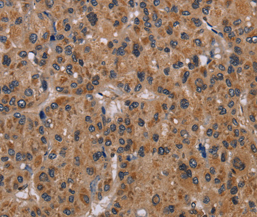 Immunohistochemistry of paraffin-embedded Human liver cancer tissue using GRK1 Polyclonal Antibody at dilution 1:30