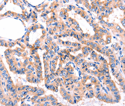 Immunohistochemistry of paraffin-embedded Human thyroid cancer tissue using GRK2 Polyclonal Antibody at dilution 1:87