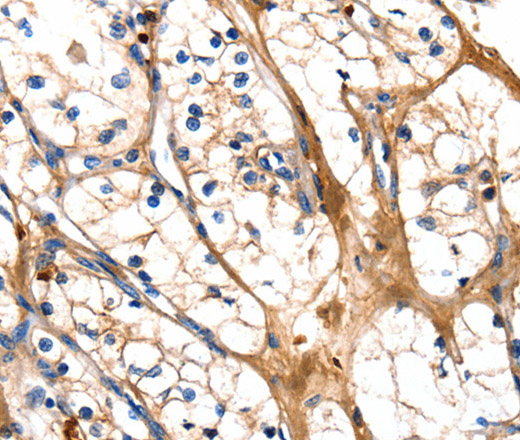 Immunohistochemistry of paraffin-embedded Human renal cancer tissue using GSK3 alpha Polyclonal Antibody at dilution 1:50