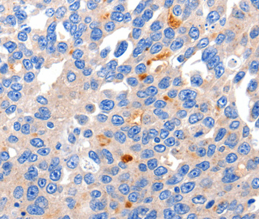 Immunohistochemistry of paraffin-embedded Human liver cancer tissue using KCNH8 Polyclonal Antibody at dilution 1:50