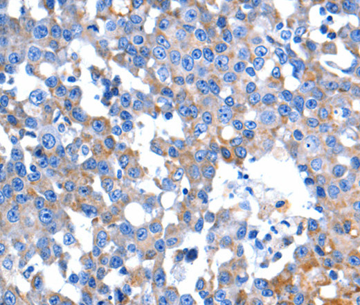 Immunohistochemistry of paraffin-embedded Human breast cancer tissue using HINT2 Polyclonal Antibody at dilution 1:60