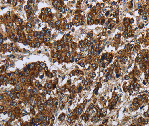 Immunohistochemistry of paraffin-embedded Human liver cancer using PPP1R13L Polyclonal Antibody at dilution of 1:30