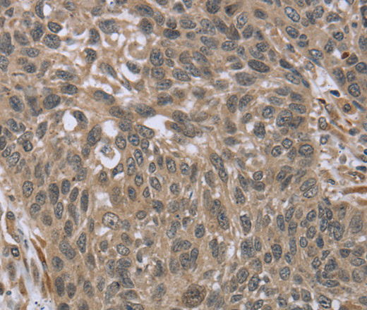 Immunohistochemistry of paraffin-embedded Human lung cancer tissue using IL15RA Polyclonal Antibody at dilution 1:45