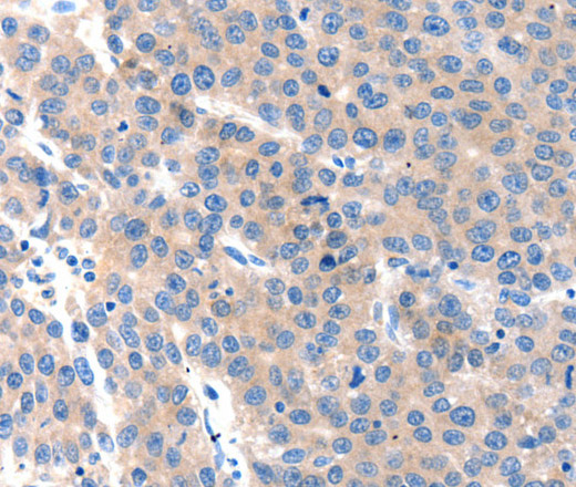 Immunohistochemistry of paraffin-embedded Human liver cancer tissue using KLK2 Polyclonal Antibody at dilution 1:100