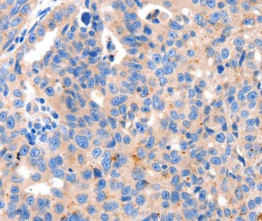 Immunohistochemistry of paraffin-embedded Human ovarian cancer tissue using KLK2 Polyclonal Antibody at dilution 1:100