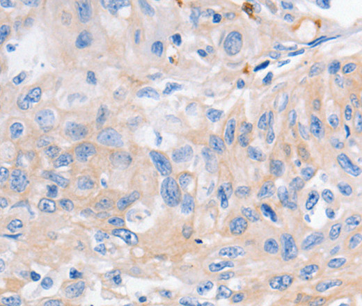 Immunohistochemistry of paraffin-embedded Human cervical cancer using KCNA1 Polyclonal Antibody at dilution of 1:30